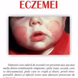 Cum să faci faţă eczemei - Paperback brosat - Jill Eckersley - Antet Revolution